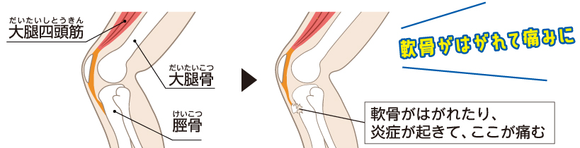 軟骨がはがれて痛みに