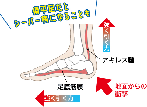 偏平足だとシーバー病になることも