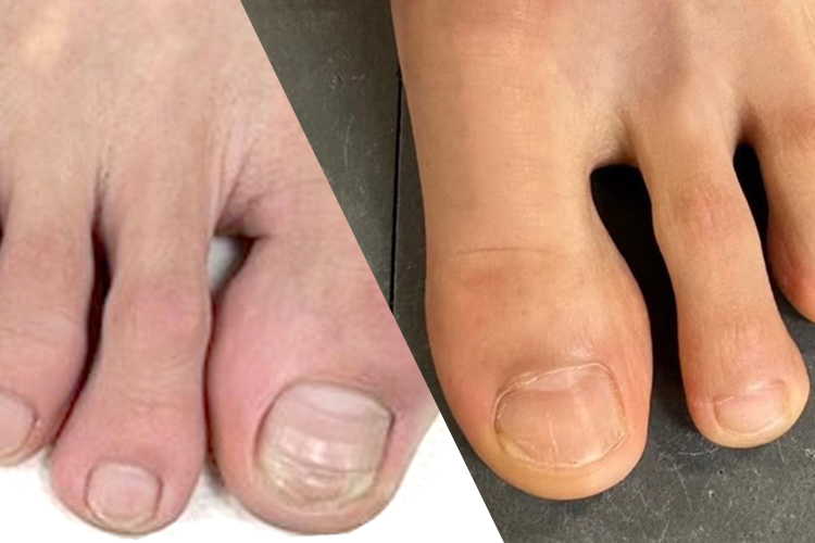 足の爪を正しく切っていますか?