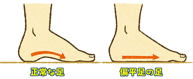 運動能力の高い子どもは「偏平足」に見えてしまうことも